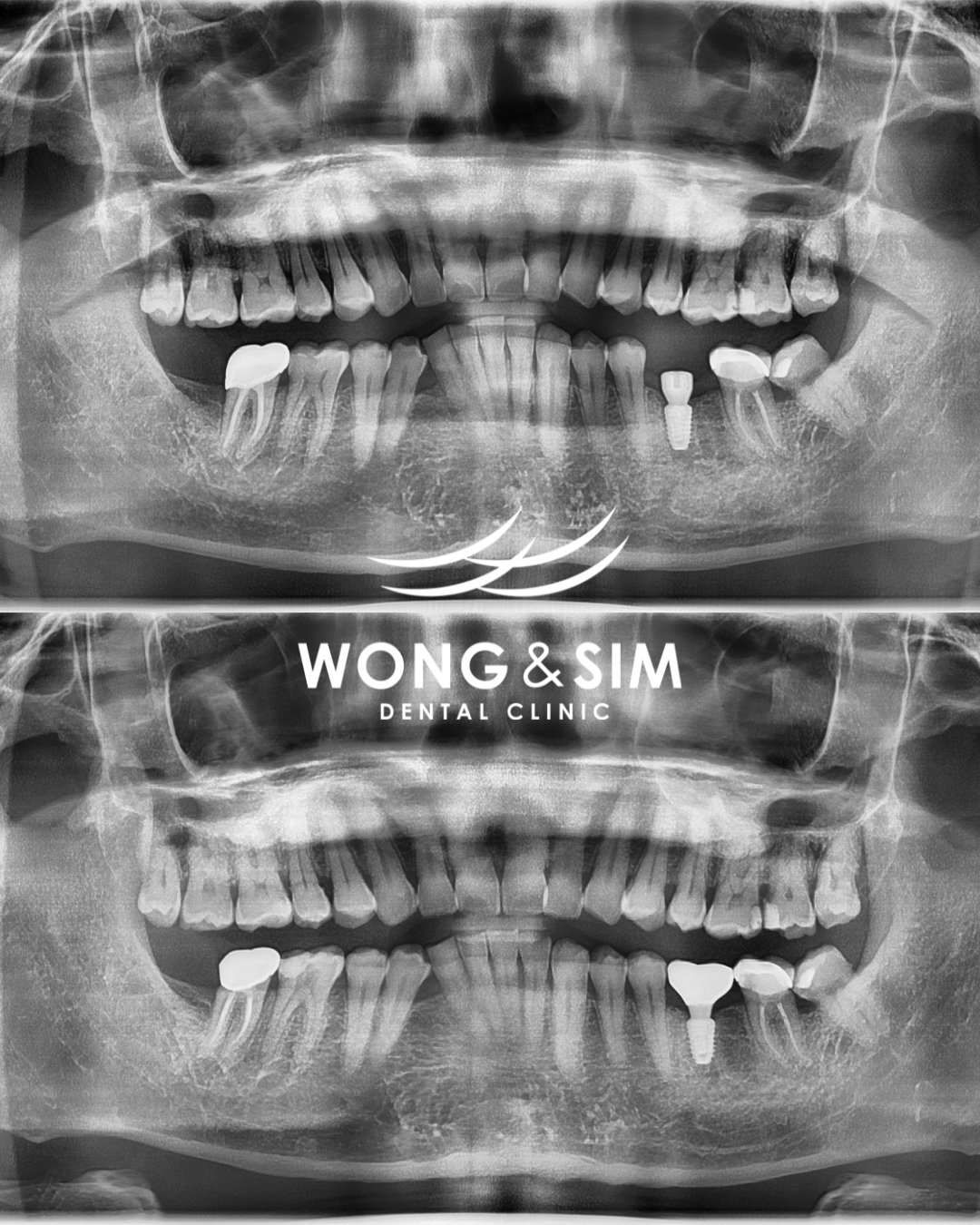 Implant Patient 8