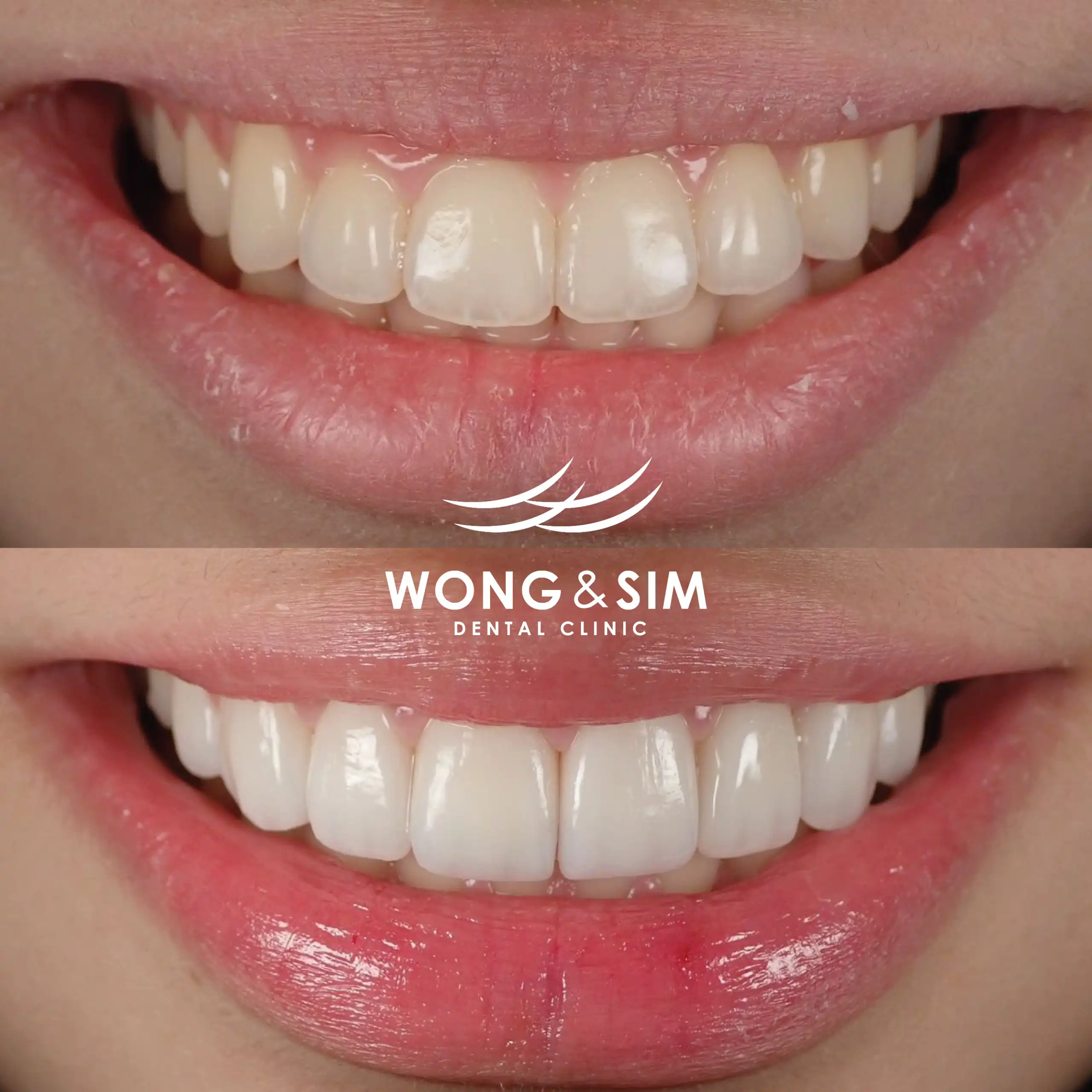 Before and after image of patient 1's teeth after dental treatment.