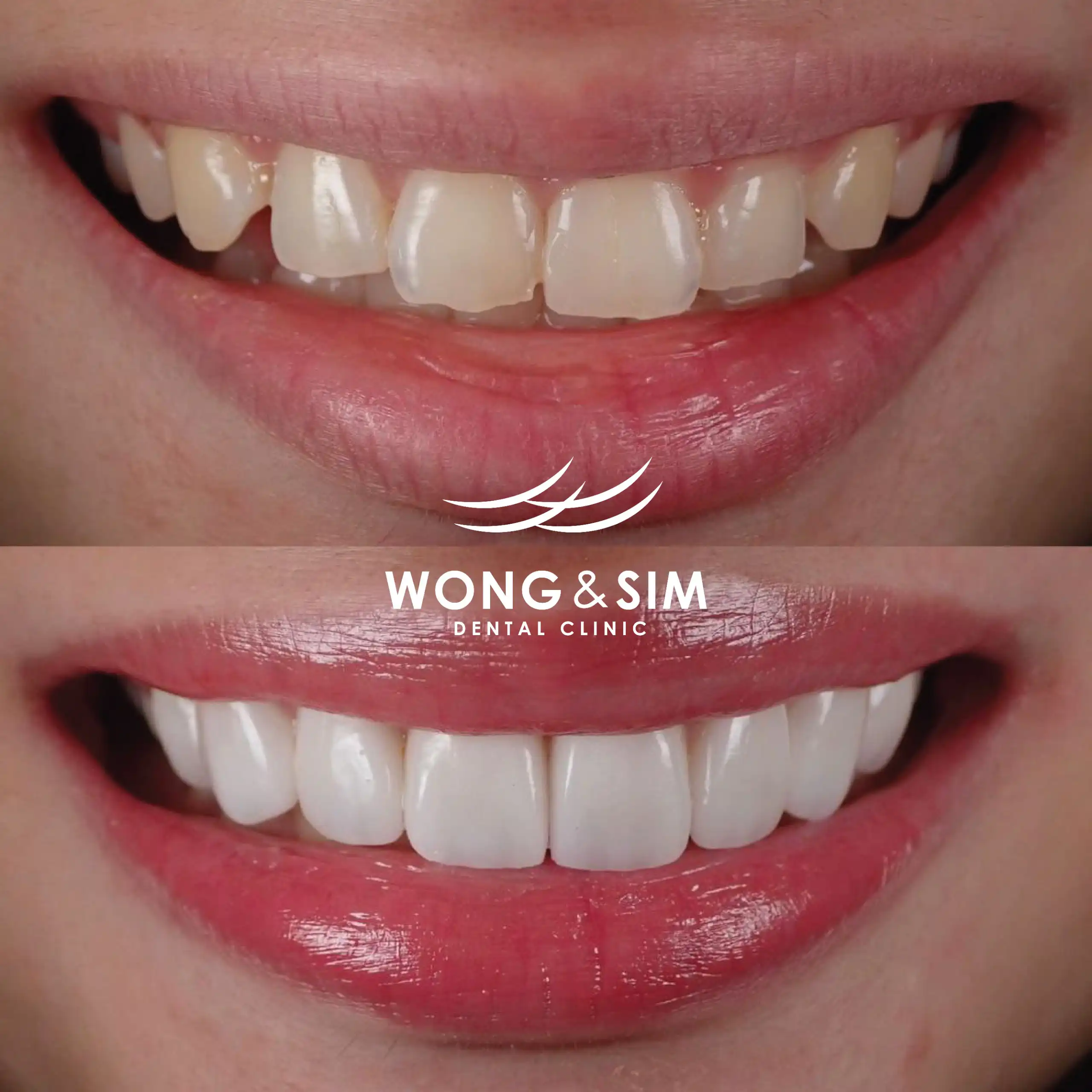 Before and after image of patient 10's teeth after dental treatment.