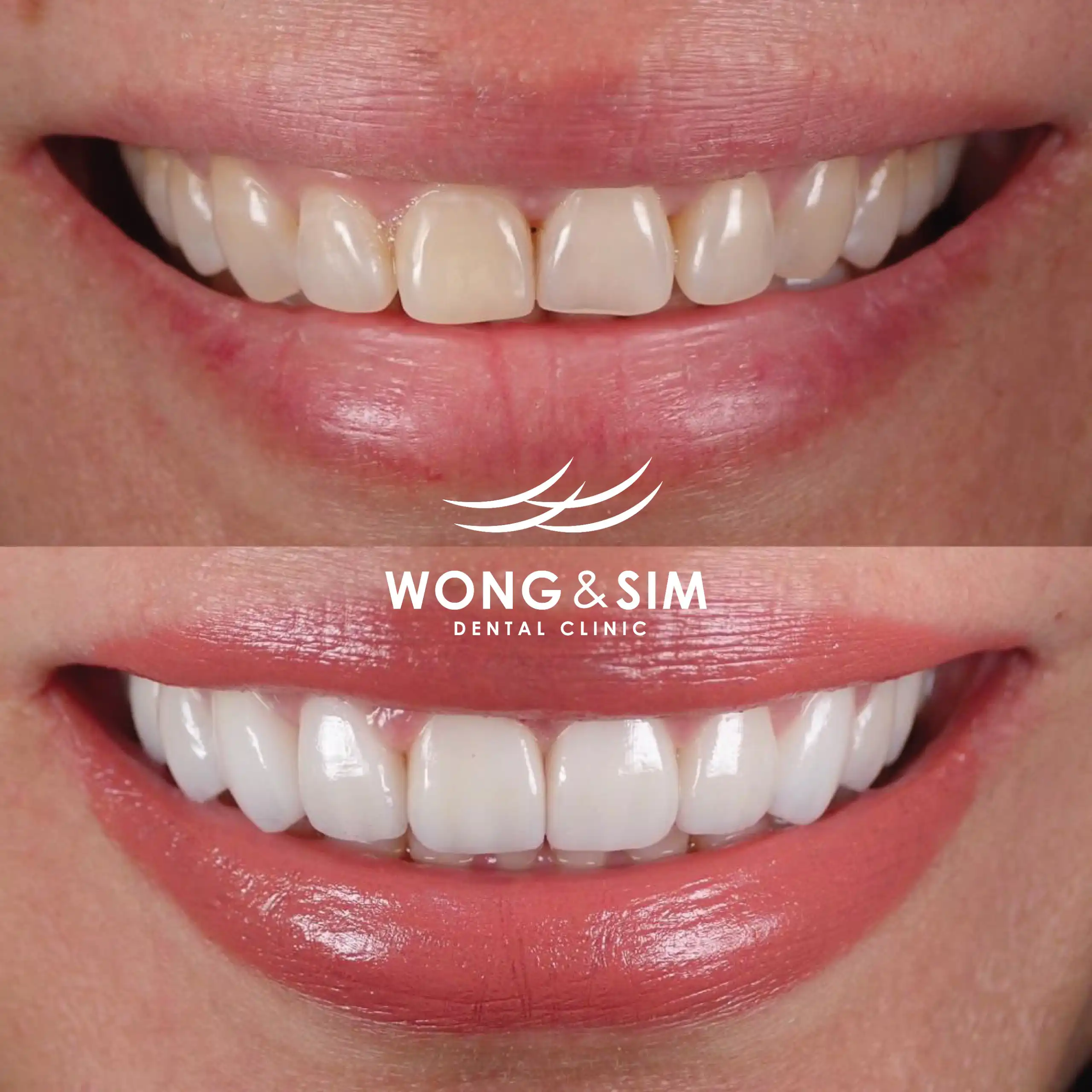 Before and after image of patient 11's teeth after dental treatment.