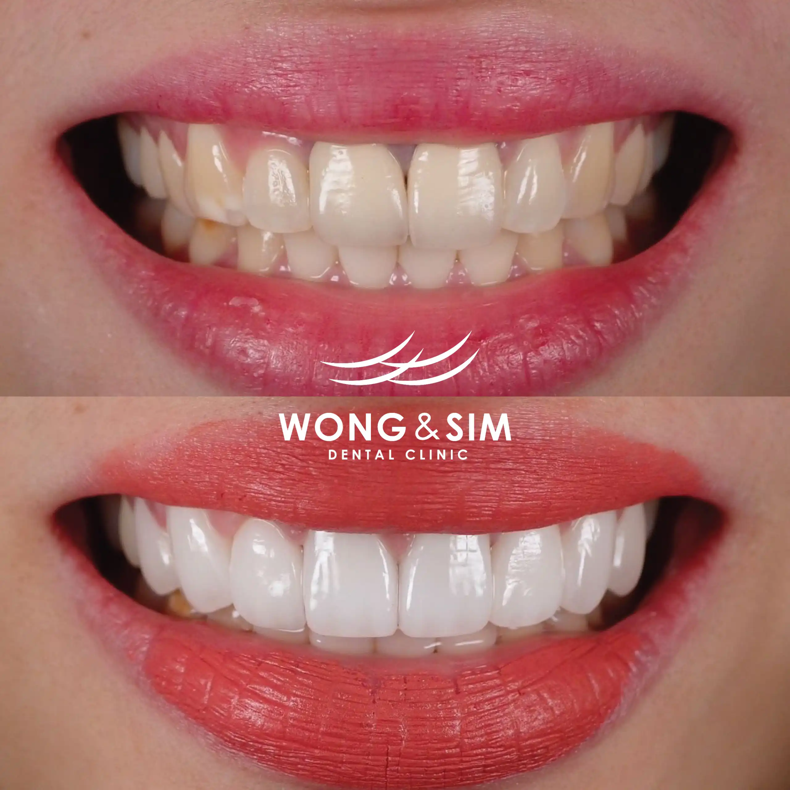 Before and after image of patient 5's teeth after dental treatment.