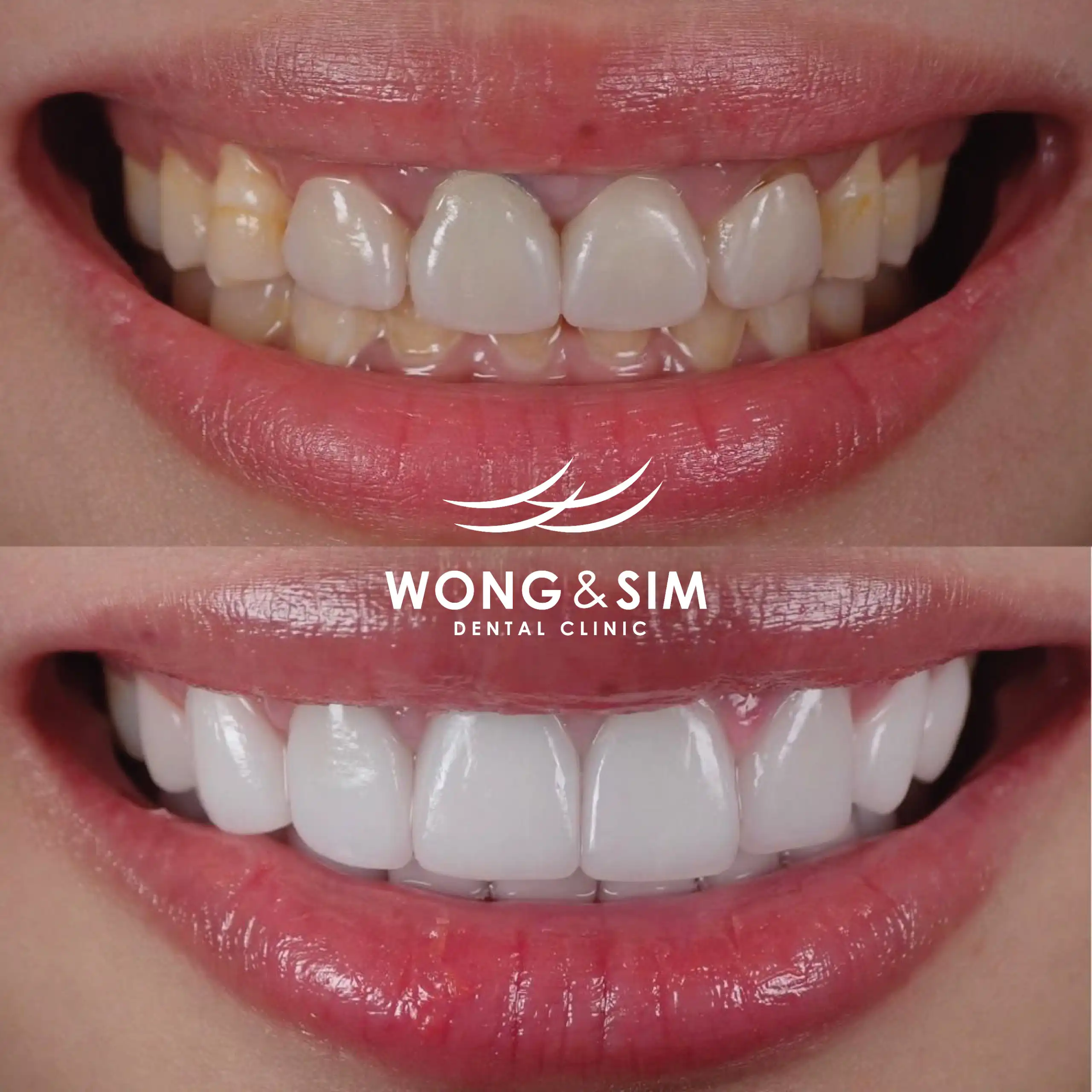 Before and after image of patient 7's teeth after dental treatment.